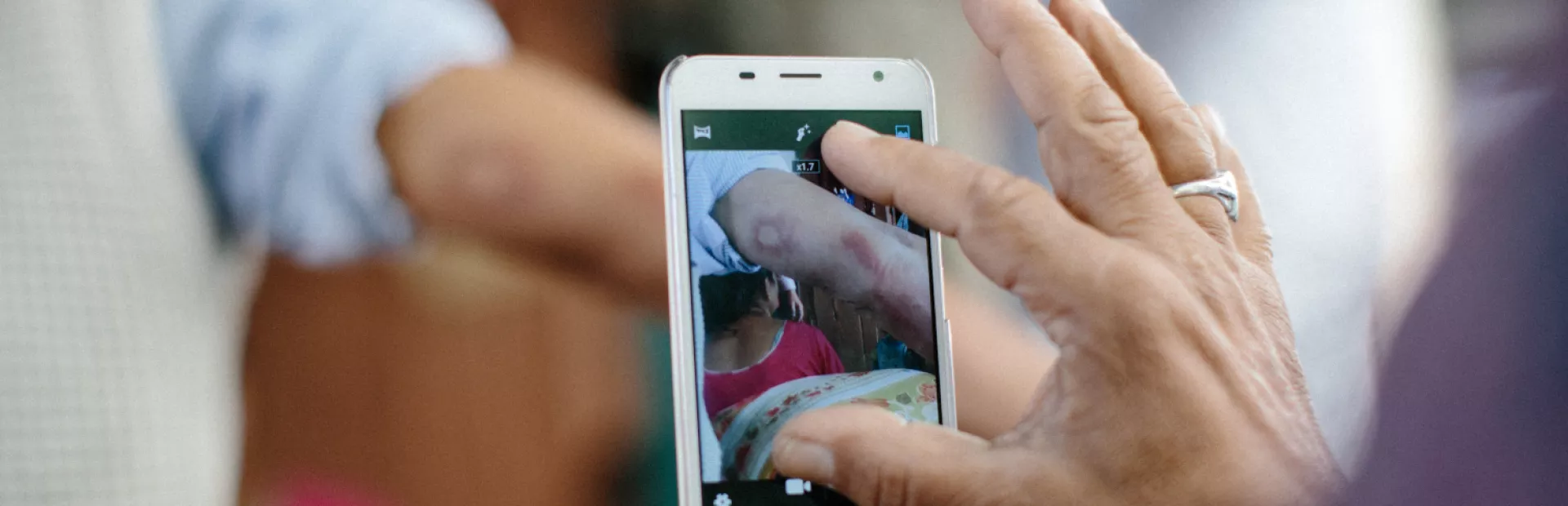 Person taking photo with its mobile phone of a leprosy lesion for AI-enabled and accelerated leprosy detection